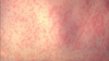 Texas measles outbreak 2025: 2 new cases reported as state reduces number of 'outbreak counties'